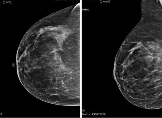 mammographie à l'ICM Montpellier 
